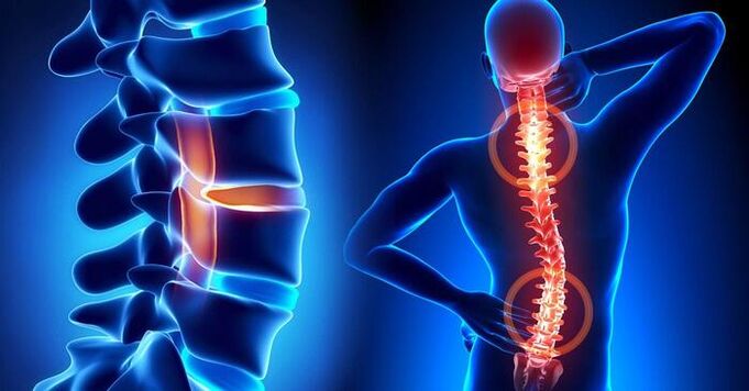 localización da dor na osteocondrose