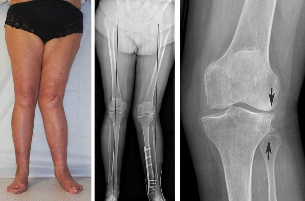 A artrose avanzada das articulacións do xeonllo é claramente visible visualmente mesmo sen radiografías